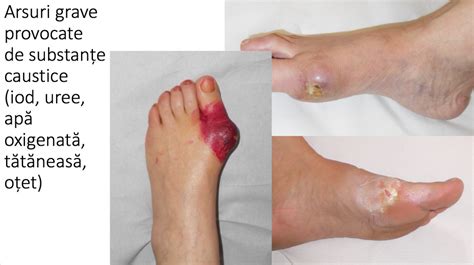 varicele interne oracle pe partea inferioară a piciorului cauza bolii